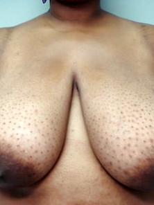Saggy Breast Reduction: Coco Tits