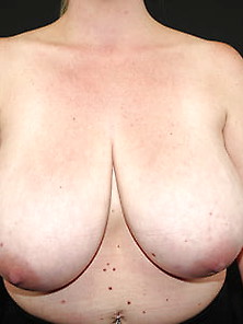 Saggy Tits-Breast Reduction 034