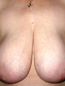 Saggy Tits-Breast Reduction 032