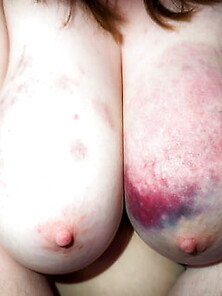 My Bruised Tits After A Rough Bdsm Session