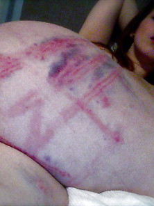 Sexy Bdsm Bruises